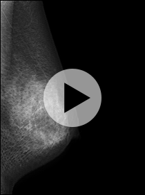 3Dマンモグラフィー画像サンプル